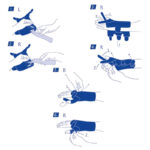 Svart ortos buren på höger hand med tumma stabiliserad